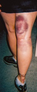raftingbruise_edited